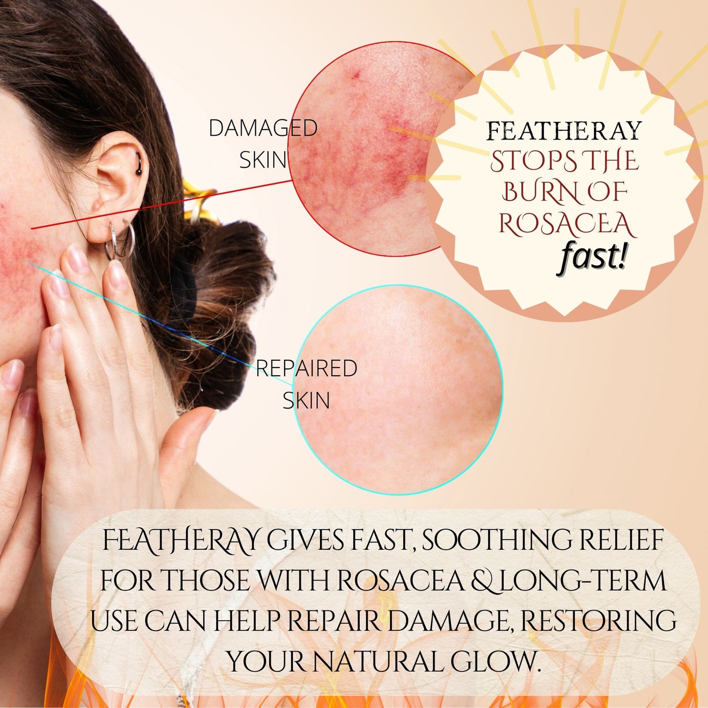 Advertisement for Featheray product showing before and after effects on skin with text about Rosacea relief.