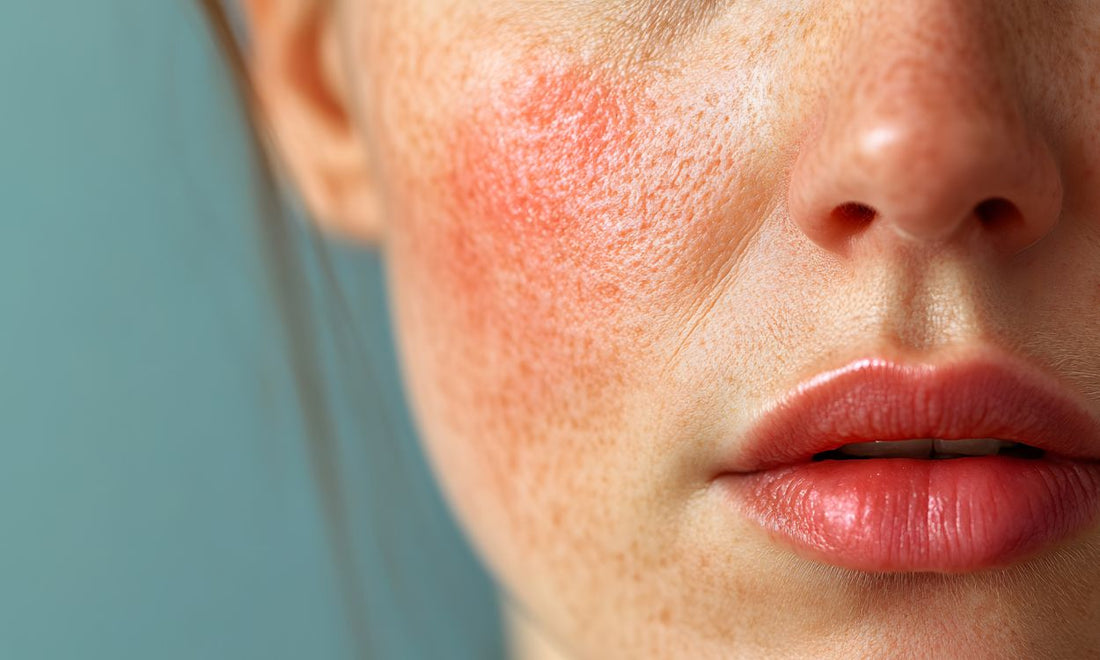 closeup of sensitive skin with rosacea