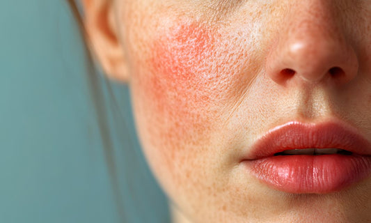 closeup of sensitive skin with rosacea